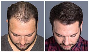 Bosley Hair Transplant & Restoration .